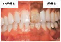 歯周病とタバコの関係 あんざい歯科クリニックは 福岡県福岡市東区香椎で地域を大事に 歯科 インプラントを営む歯科クリニックです