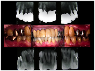 歯周病の実例
